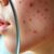 Dermatolog na trądzik: kiedy umówić wizytę i jakie metody leczenia warto rozważyć