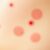 Czerwone plamy po trądziku: przyczyny, skuteczna pielęgnacja i kiedy sięgnąć po zabiegi dermatologiczne